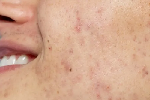 Laser Toning (Q-Switched Nd:YAG)