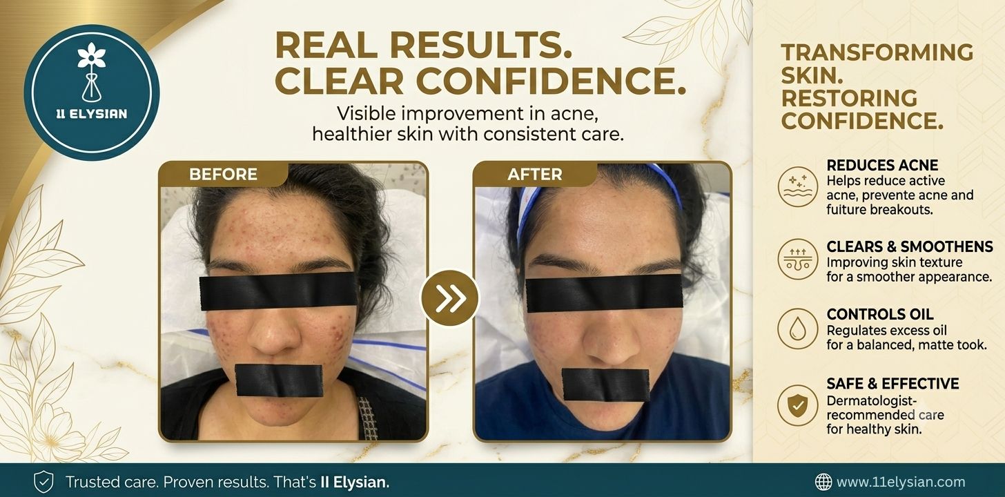 Acne Treatment Near Techzone 4, Greater Noida West