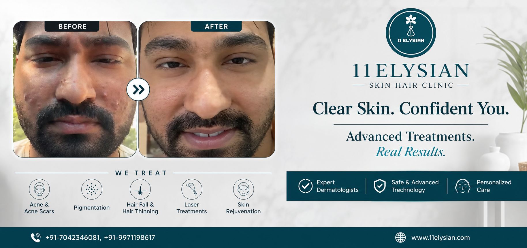 Acne Treatment Near Noida Extension