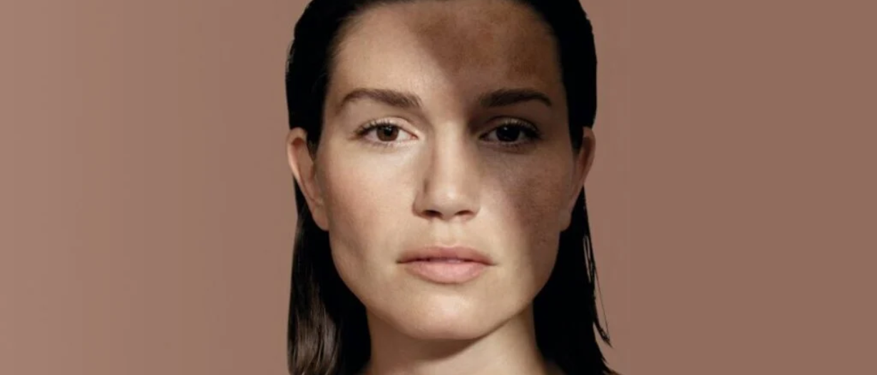 Tranexamic Acid Peel