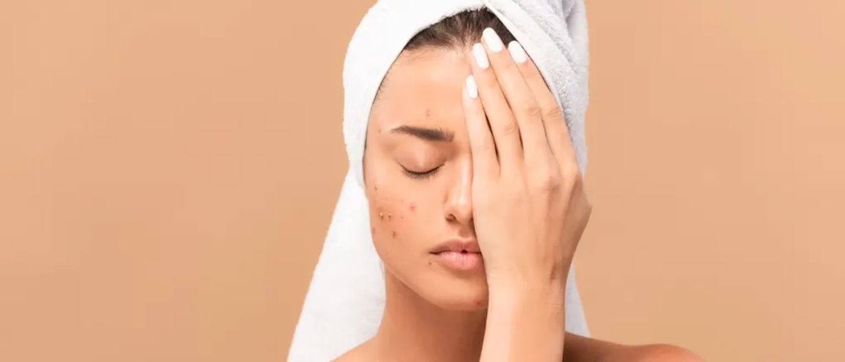 Azelac Peel (Acne marks)