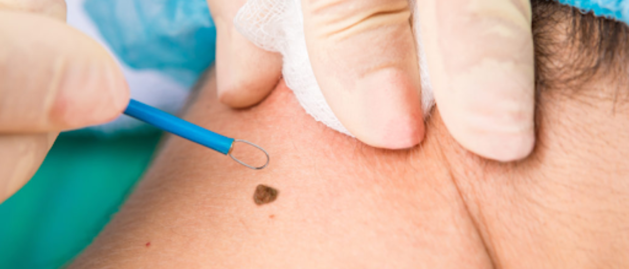 RF Cautery (skin tags /warts)