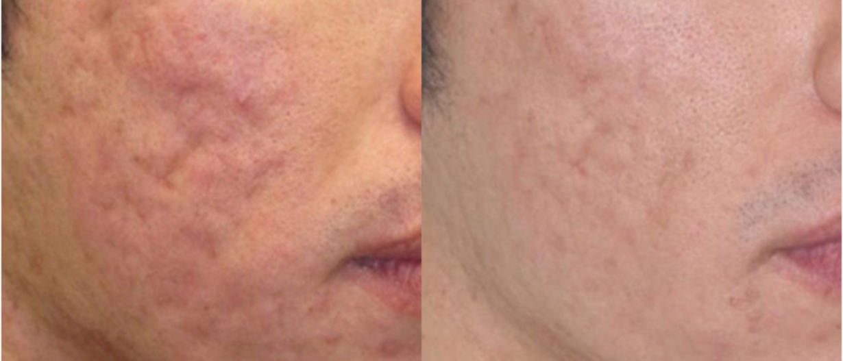 Fractional Laser  (Acne scars)