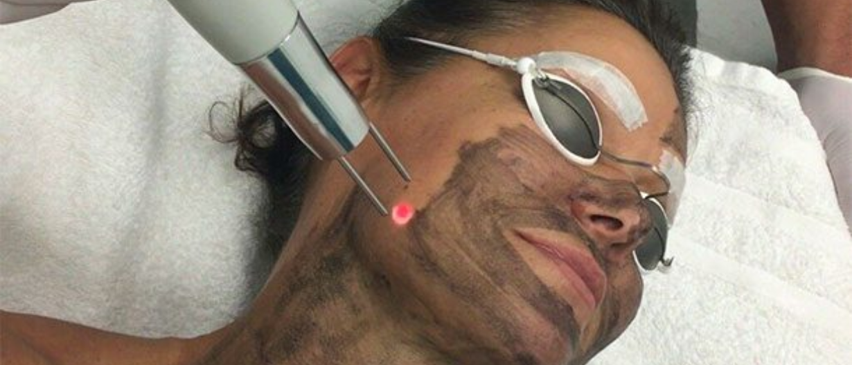 Carbon Laser Treatment