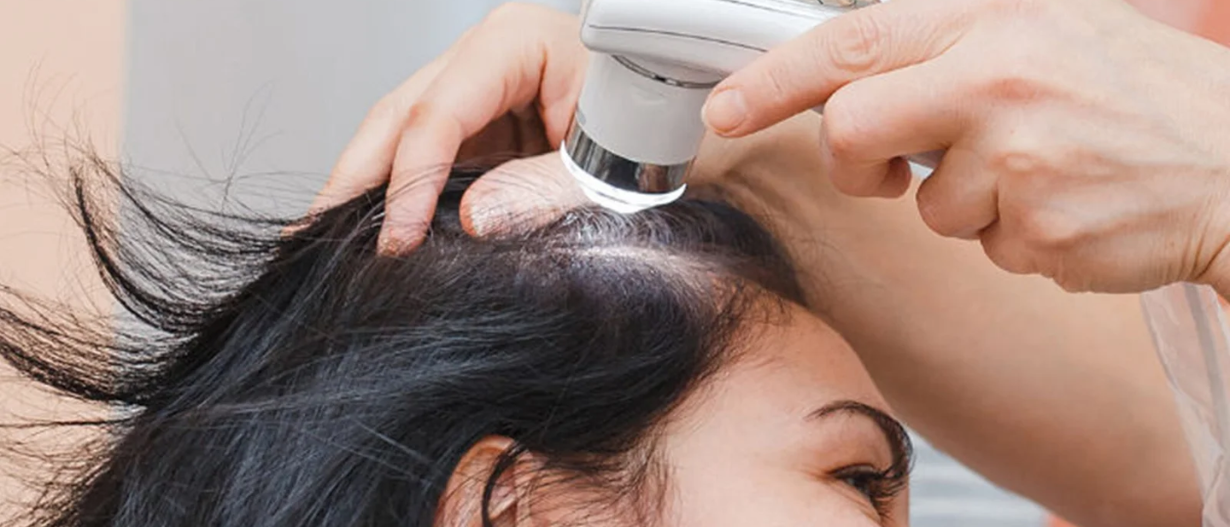 Exosome Therapy for Hair Regrowth