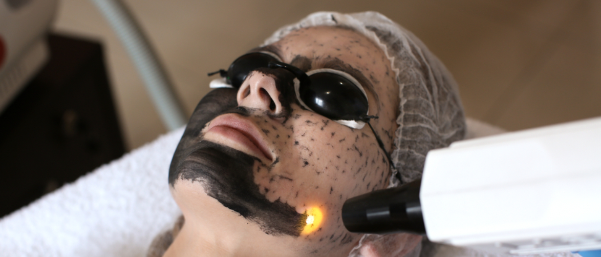 Carbon Facial (Hollywood Peel)